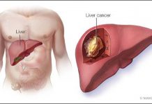 3 bệnh ung thư “sát thủ” hàng đầu với đàn ông Việt - 1