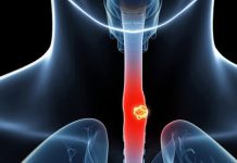 Chế độ ăn uống ảnh hưởng thế nào đến nguy cơ mắc ung thư thực quản? - 1