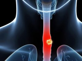 Chế độ ăn uống ảnh hưởng thế nào đến nguy cơ mắc ung thư thực quản? - 1