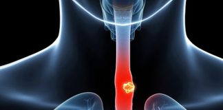 Chế độ ăn uống ảnh hưởng thế nào đến nguy cơ mắc ung thư thực quản? - 1