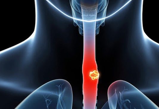 Chế độ ăn uống ảnh hưởng thế nào đến nguy cơ mắc ung thư thực quản? - 1