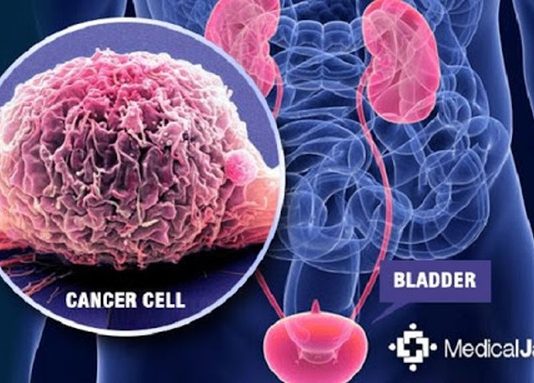 Phát hiện mới về mối liên quan giữa ung thư bàng quang và hút thuốc lá - 1