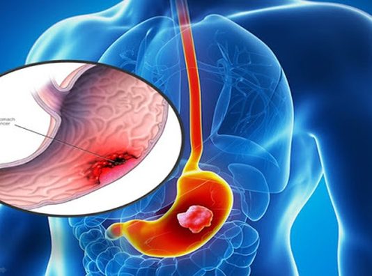 Các nhà khoa học Nhật Bản giải mã lý do người Châu Á dễ mắc ung thư dạ dày - 1