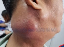 Sờ thấy hạch cổ sau một đêm ngủ dậy, hoảng hồn liệu có phải ung thư? - 1