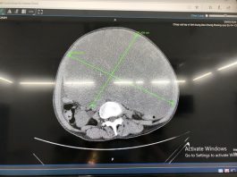 Từ chối can thiệp sớm, bệnh nhân mang khối u ác tính khổng lồ - 1