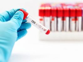 Ý nghĩa của chỉ số CEA trong bệnh ung thư - 1