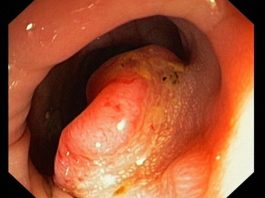 Có dấu hiệu này, tế bào ung thư đã ken đặc ruột - 1