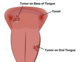 Dấu hiệu ung thư lưỡi giai đoạn cuối - 1