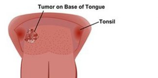 Dấu hiệu ung thư lưỡi giai đoạn cuối - 1