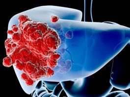 Đừng bỏ qua dấu hiệu của 5 bệnh ung thư thường gặp này - 1