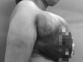 Bỏ dở điều trị ung thư vú, người phụ nữ mọc khối u mới to như quả bưởi - 1