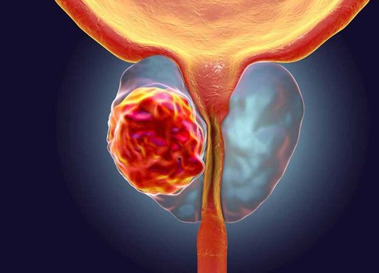 Loại thuốc mới tiếp thêm hy vọng cho bệnh nhân ung thư tuyến tiền liệt - 1