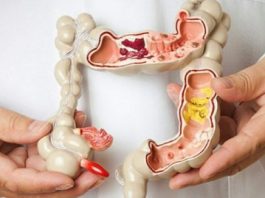Cảnh giác với ung thư đại trực tràng nếu có nhiều hơn 3/5 dấu hiệu này - 1
