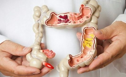 Cảnh giác với ung thư đại trực tràng nếu có nhiều hơn 3/5 dấu hiệu này - 1