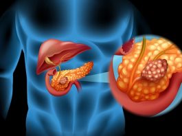 Ung thư tụy khó phát hiện sớm, tỷ lệ tử vong cao - 1