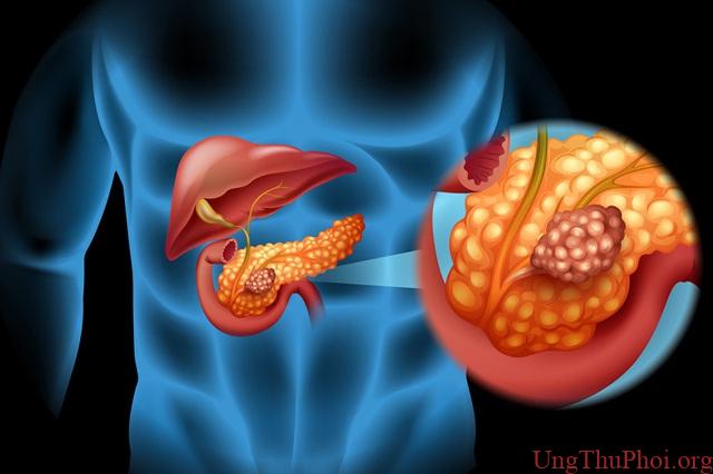 Ung thư tụy khó phát hiện sớm, tỷ lệ tử vong cao - 1 Ung thư tụy khó phát hiện sớm, tỷ lệ tử vong cao - 1