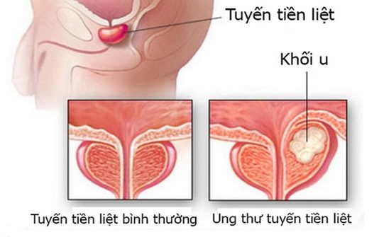 Đừng bỏ qua những dấu hiệu cảnh báo loại ung thư ác mộng với nam giới - 1
