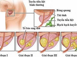 Dấu hiệu ung thư tiền liệt tuyến giai đoạn cuối - 1