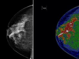 Phát hiện cách ngăn chặn sự phát triển loại ung thư vú phổ biến nhất - 1