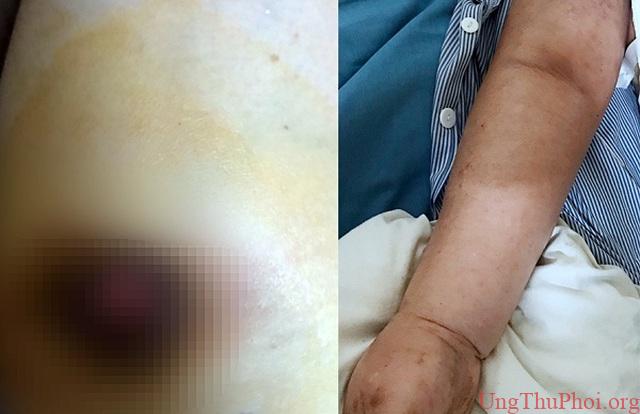 Vỡ loét đầu vú vì tự ý đắp lá chữa ung thư - 1 Vỡ loét đầu vú vì tự ý đắp lá chữa ung thư - 1