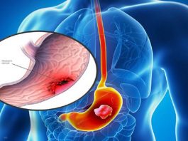 3 bệnh thường gặp cần điều trị ngay nếu không muốn ung thư ghé thăm - 1