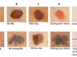 Dấu hiệu nhận biết sớm nốt ruồi ác tính - 1
