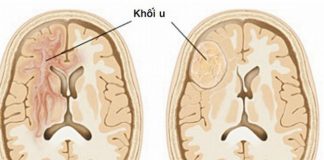 Dấu hiệu cảnh báo u não - 1
