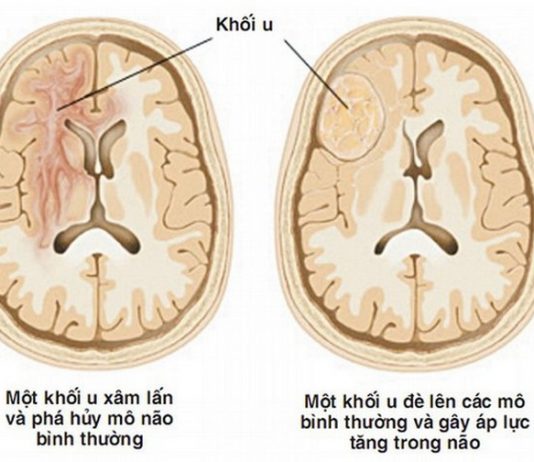 Dấu hiệu cảnh báo u não - 1