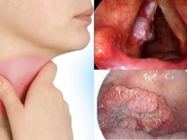 Nhận biết dấu hiệu ung thư thanh quản để không bỏ lỡ thời gian vàng - 1