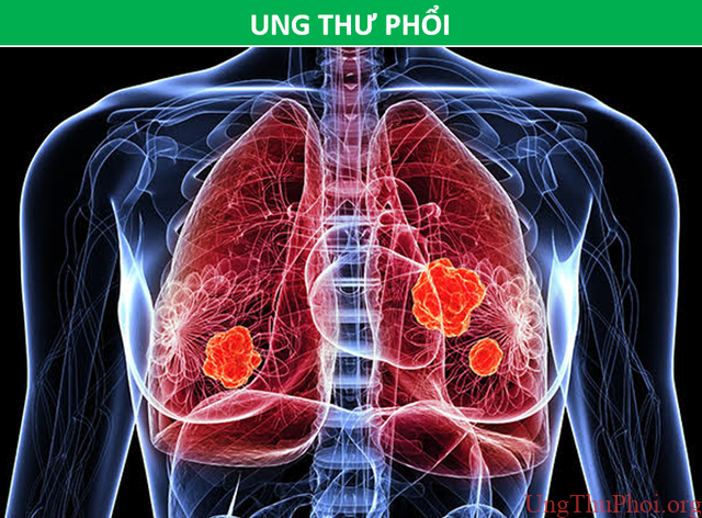 Những phương pháp tầm soát ung thư giúp bạn chủ động trước bệnh tật - 7 Những phương pháp tầm soát ung thư giúp bạn chủ động trước bệnh tật - 7