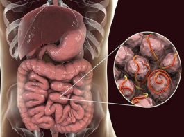 5 dấu hiệu tưởng vô hại nhưng lại là tín hiệu ung thư ruột phát triển - 1