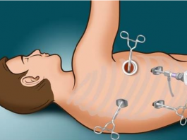 Phương pháp mổ đột phá giúp cắt bỏ ung thư phổi với vết rạch chỉ 6 cm - 1