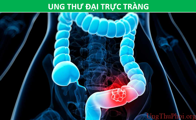 Những phương pháp tầm soát ung thư giúp bạn chủ động trước bệnh tật - 5 Những phương pháp tầm soát ung thư giúp bạn chủ động trước bệnh tật - 5