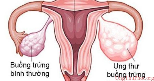 Bé 11 tuổi mắc ung thư buồng trứng nhưng bố mẹ nhầm là béo bụng - 2 Bé 11 tuổi mắc ung thư buồng trứng nhưng bố mẹ nhầm là béo bụng - 2