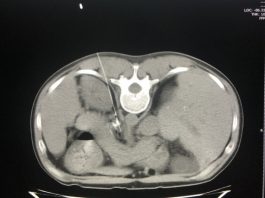 Diệt đám rối thần kinh tạng: Chấm dứt đau đớn cho bệnh nhân ung thư - 1