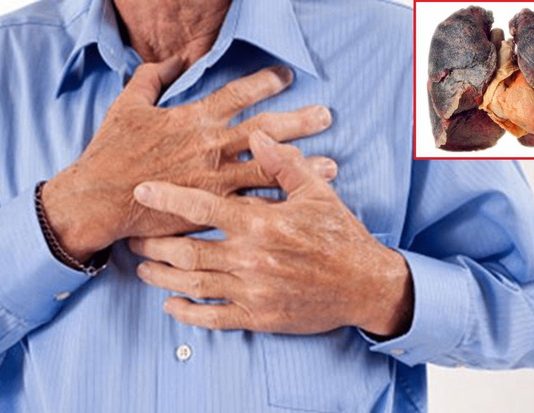 Ho ra máu tươi, cụ ông đi khám phát hiện ung thư phổi giai đoạn cuối - 1
