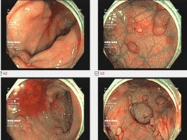 Đi ngoài ra máu, người phụ nữ phát hiện hơn 100 polyp trong đại tràng - 1