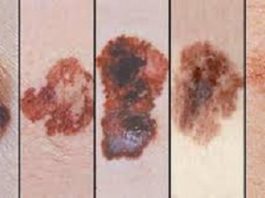 Phát triển miếng dán điều trị ung thư da - 1