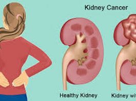 Đau hông coi chừng ung thư thận - 1