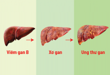 xo gan nguyen nhan dau hieu trieu chung va dieu tri