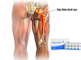 Thuốc Neurobion chữa bệnh đau thần kinh toạ tốt không?