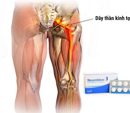 Thuốc Neurobion chữa bệnh đau thần kinh toạ tốt không?
